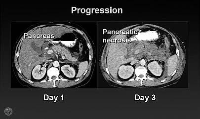 Focal or diffuse enlargement of the pancreas with enhancement of the parenchyma in response to IV