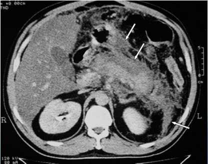 Classification of severity: Revised Atlanta classification Mild acute pancreatitis which is characterized by the absence of organ failure and local or systemic complications Moderately severe acute