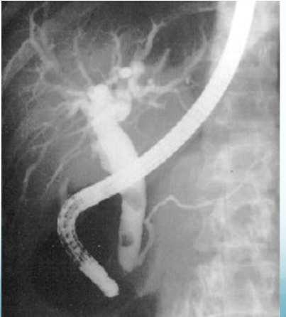 Biliary Colic/Acute Cholecystitis (3) Percutaneous Cholecystostomy Delayed presentation Sick/elderly Distended, obstructed gallbladder on U/S Management of common bile duct stones Effective, safe