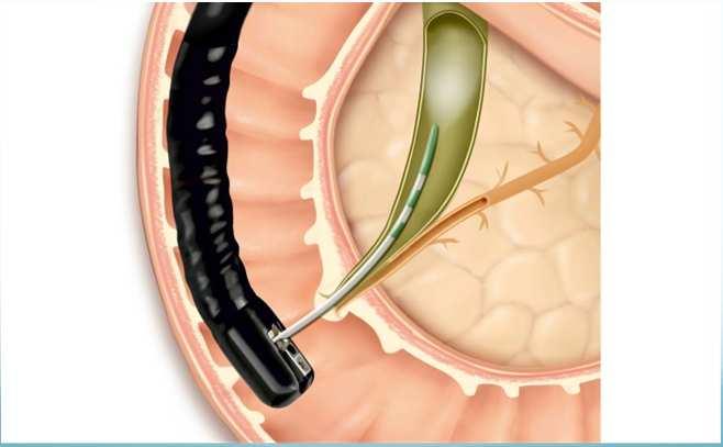 ERCP anatomical difficulties Access problems due to