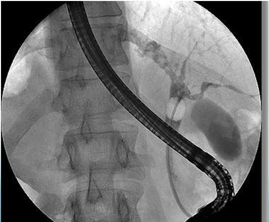 extraction ERCP stent insertion