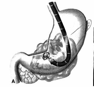 Aggressive endoscopic therapy for pancreatic necroses Uncontrolled, retrospective study ERP, EUS-Cystogastrostomy, daily necrosectomy, sealing of fistula (Acrylat) Endoscopic drainage of abscesses
