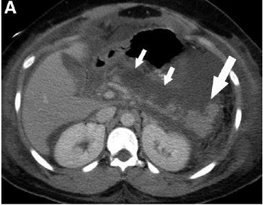 Acute Fluid Collection Associated with interstitial pancreatitis Homogenous collection with fluid density confined by normal
