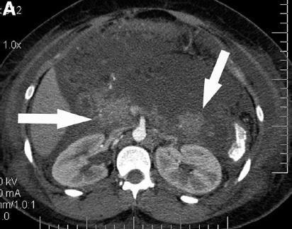 Acute Necrotic Collection Fluid and necrotic collection of the pancreatic parenchyma or peripancreatic
