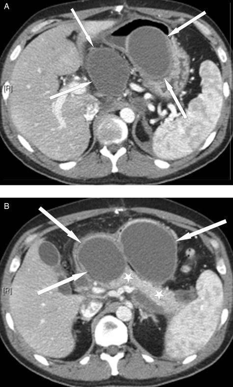Pancreatic Pseudocyst Well circumscribed, encapsulated fluid collection with a well defined inflammatory wall