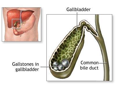Etiology - I GET SMASHED I: idiopathic G: gallstones E: ethanol