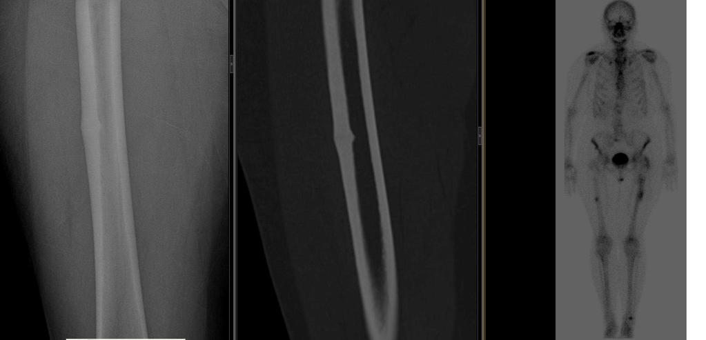 X-ray, CT, Bone