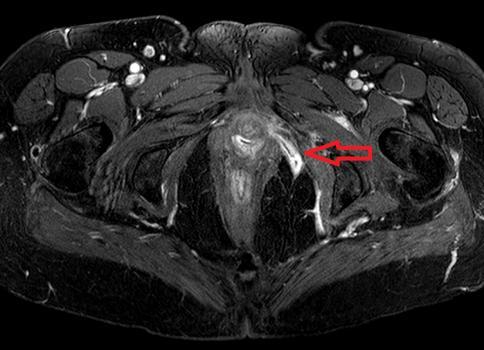2 MRI images showing