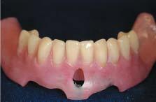 Attention at implant placement avoided parallelism problems that could not be reconciled by minor extraoral adjustment of the abutment.