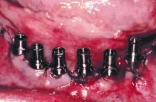 (Right) Using autopolymerizing acrylic resin, the temporary titanium cylinders were then indexed within a hollowed-out purpose-made interim denture and carefully contoured and polished.