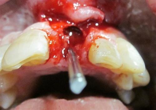 3. After removal of the tooth