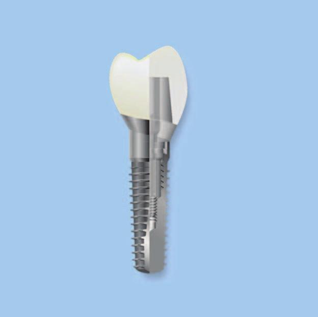 Continued from page 25 Tapered Implants Although excellent results can be obtained when placing standard implants in fresh extraction sites, tapered anatomically shaped implants are the implants of