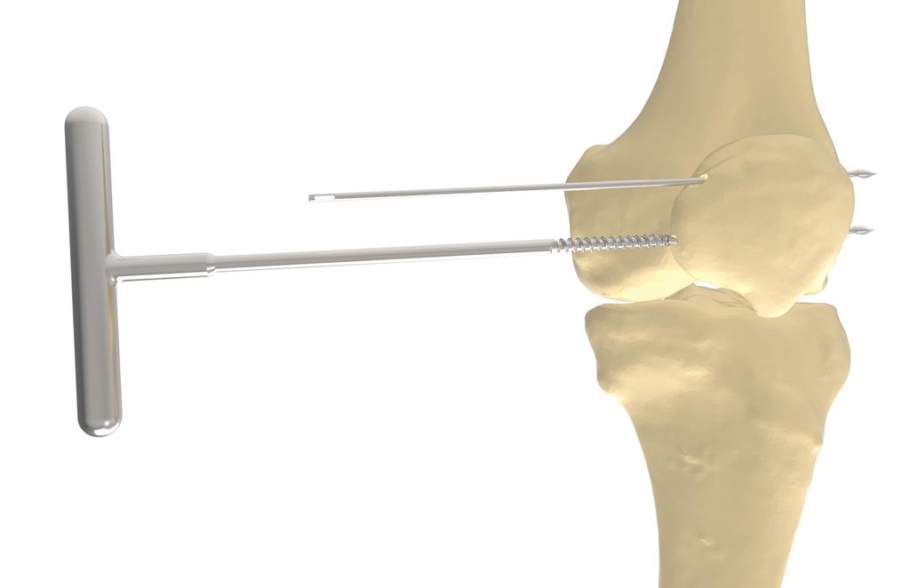 DOUBLE BUNDLE TECHNIQUE Tapping the Patella As the patella is a dense, thick bone, tapping prior to screw insertion is recommended.
