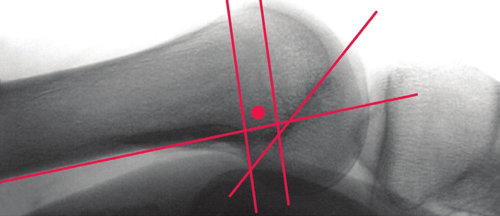 DOUBLE BUNDLE TECHNIQUE FEMORAL PREPARATION Pin Placement The correct femoral insertion of the MPFL is essential to maintain proper biomechanics of the patellofemoral joint.