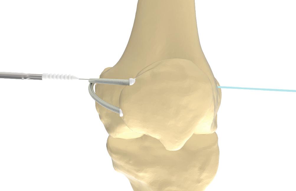 DOUBLE BUNDLE TECHNIQUE SECURING THE GRAFT TO THE FEMUR Identify the space between the vastus medialis and the capsule of the medial knee.