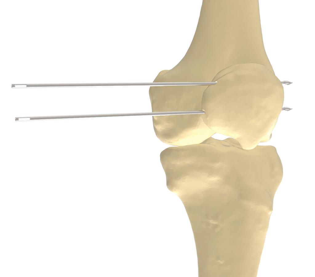 DOUBLE BUNDLE TECHNIQUE PATELLAR PREPARATION Pin Placement Make an incision along the medial border of the patella and expose the medial patella, taking care not to open the joint capsule.