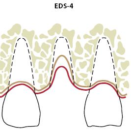 Delayed implant placement into damaged extraction socket EDS-classification ( extraction defects sounding ) EDS class 3 moderate compromise of local tissues 1-2 compromised socket walls vertical or