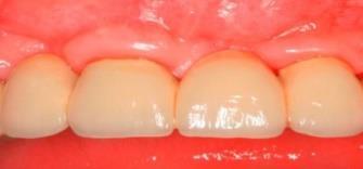 Controlled case series Tooth removal Surgery 1.