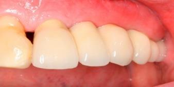further esthetic concern, temporary abutment connection 22 patients