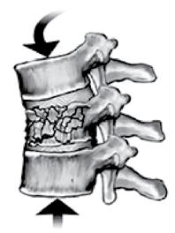 The vertebra is replaced with a metal or composite cage filled with bone graft.