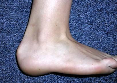 Retrocalcaneal Bursitis (Pump Bump) Cause of Injury Caused by inflammation of