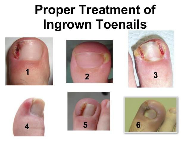 Ingrown Toenails Cause of Condition
