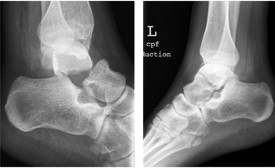 Minimally displaced /DISPLACED fractures Closed reduction which is
