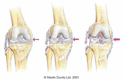 LCL Sprain Mechanism of Injury Varus force or tibial internal rotation.