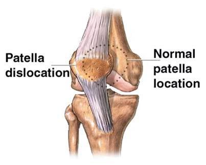 Patellar Subluxation/Dislocation Mechanism of Injury