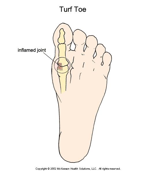 Turf Toe Mechanism of Injury Hyperextension sprain of the great toe. MP joint. Can be related to either trauma or overuse.