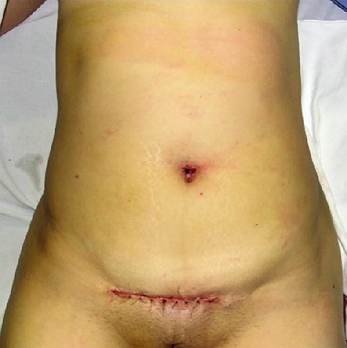 In addition, the Pfannenstiel incision may be associ- ated with a decreased rate of incisional hernia (12). When Bird et al.