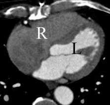 The right ventricle [R] is relatively contrast free. The left ventricle [L] is opacified optimally.