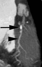 FIGURE 4. A slab maximum-intensity projection image of the left anterior descending (lower arrow) and circumflex (upper arrow) arteries. FIGURE 5.