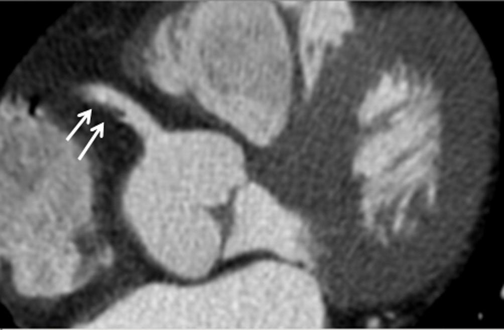 Quantitative Imaging in Medicine and Surgery, Vol 2, No2 Jun 2012 99 A B Figure 1 A non-calcified plaque (arrows in A) is shown at the proximal segment of right coronary artery on