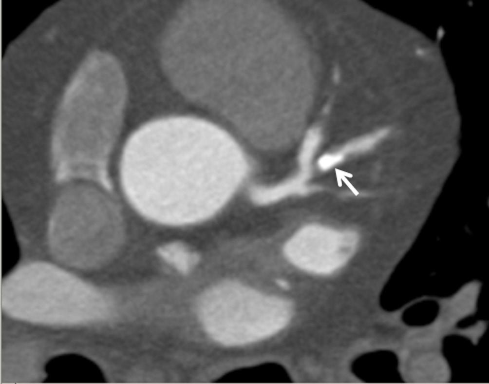 The overestimated stenosis on 2D image is due to blooming artefacts composition has important clinical implications, with increasing numbers of mixed plaques associated with