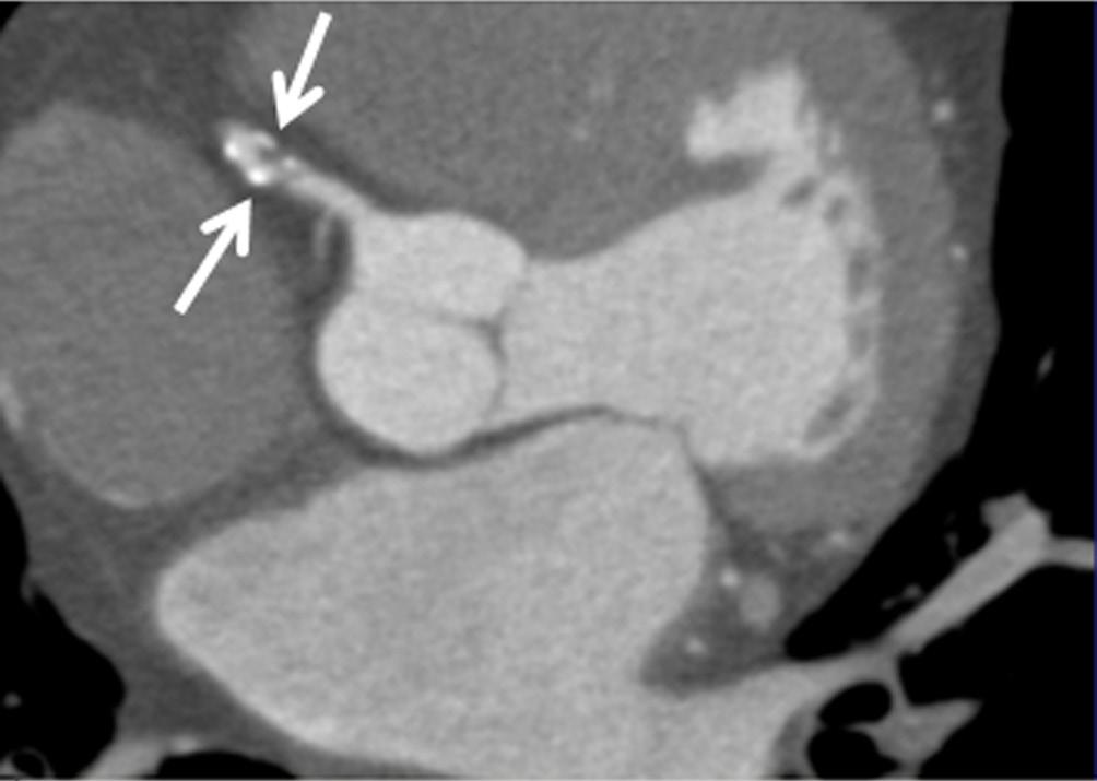 100 Sun. Cardiac CT in CAD A B Figure 3 A mixed plaque is present at the proximal segment of right coronary artery (arrows in A) on a 2D axial image.