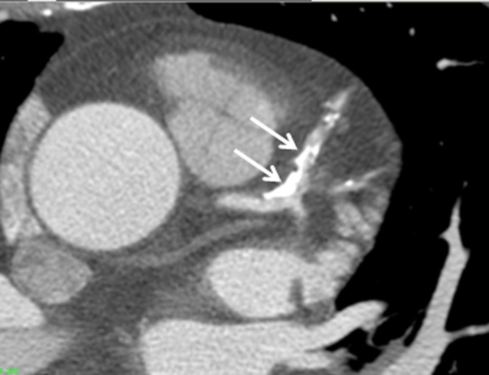 LAD-left anterior descending obstructive coronary stenosis.