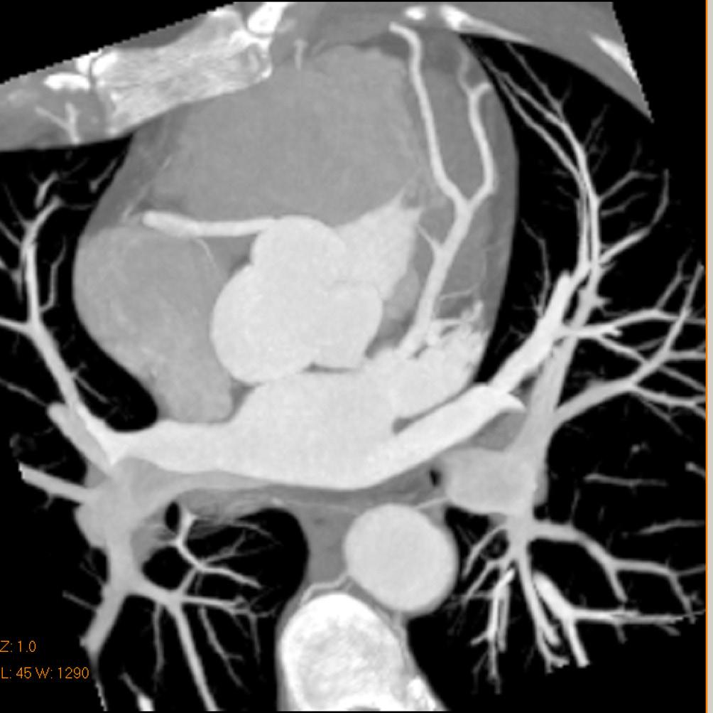 angiography shows normal right (A) and left coronary artery branches (B).
