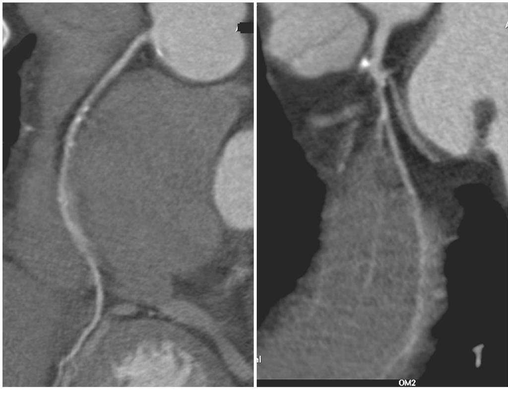 Sun. Coronary CT angiography with prospective ECG-triggering 34 A B Figure 6 Prospective ECG-triggered coronary CT angiography curved planar reformatted images of the right (A) and left coronary