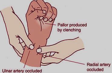 ischemic, so we do a simple test called Allen s test( the doctor presses on radial & ulnar arteries closing them, then tells the patient to move his fingers until we feel the hand start to be