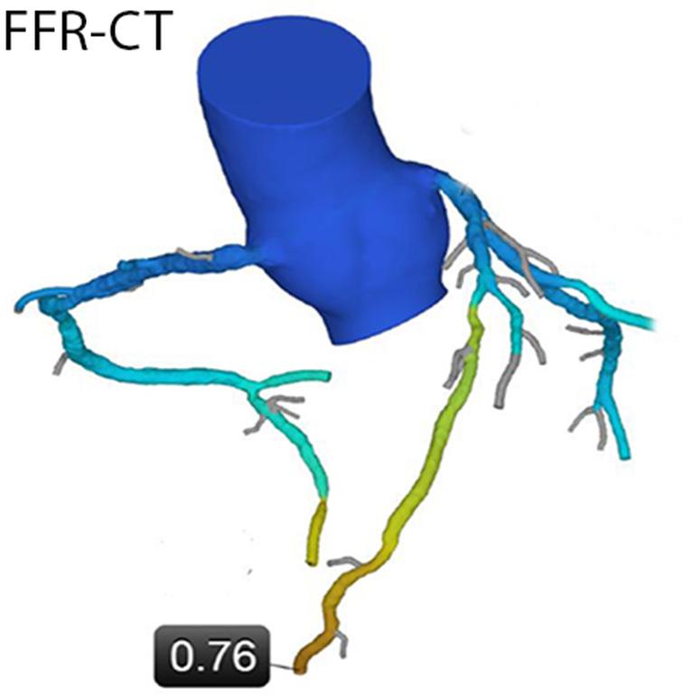 Cardiovascular Diagnosis and Therapy, Vol 7, No 5 October 2017 435 Figure 3 Simulated FFR-CT based on fluid dynamic modeling.