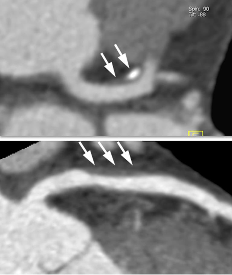 (A) Partly calcified plaque with positive remodeling in the left main coronary artery (arrows); (B) non-calcified plaque with positive remodeling in the proximal left anterior descending coronary