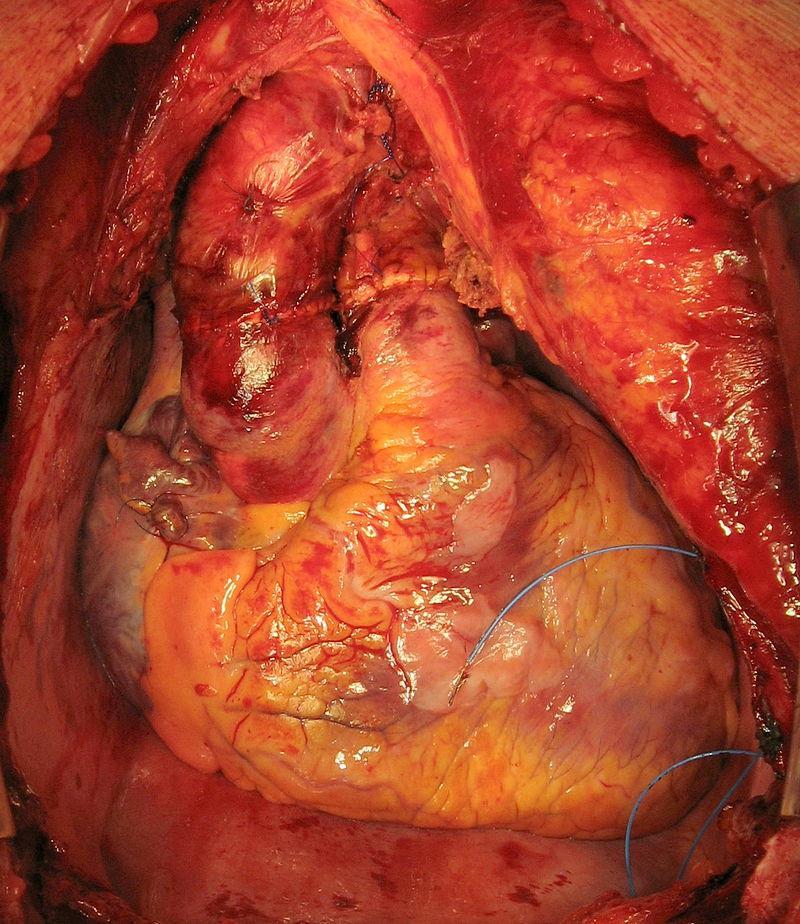 transplanted heart with