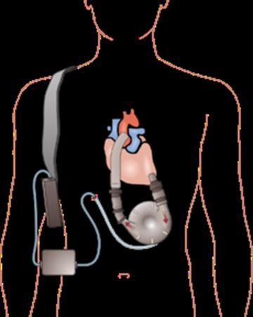 A left ventricular assist device (LVAD)