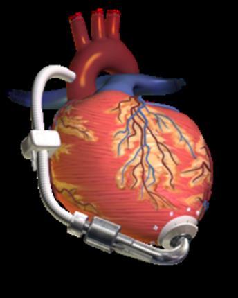 aorta, connected to an externally worn
