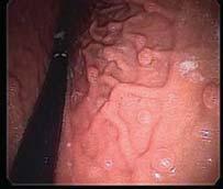 Gastric Polyps Fundic gland polyps Most common type in FAP patients Incidence: 26-61% (FAP pts) vs 0.8-1.9% (general pop.