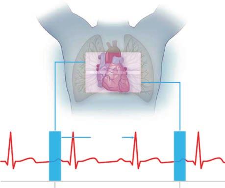 24 Cardiac CT Imaging: Diagnosis of Cardiovascular Disease Tube output 100% 20% Time Figure 2.5. ECG-based tube current modulation reduces radiation exposure.