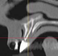 Prior to implant placement in the mandible, the inferior alveolar nerve must be visualized.