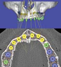 Page 5 of 8 Figure 9. A 3-D view showing dental implants in parallel position (top). Axial view of full arch showing spacing of implants (bottom).