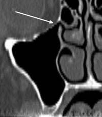When a radiopaque marker is used to demark the final tooth position, the data can be seen on a CT (Figures 8a and 8b).